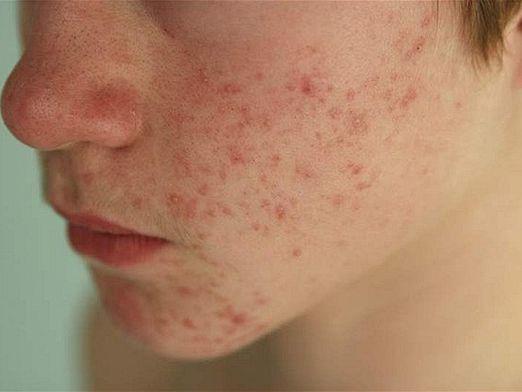 What is acne?