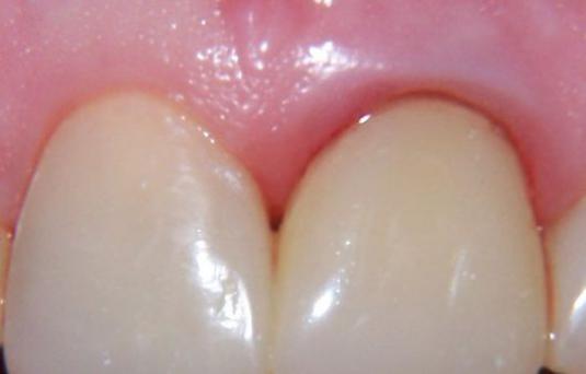 How to cure the gum?