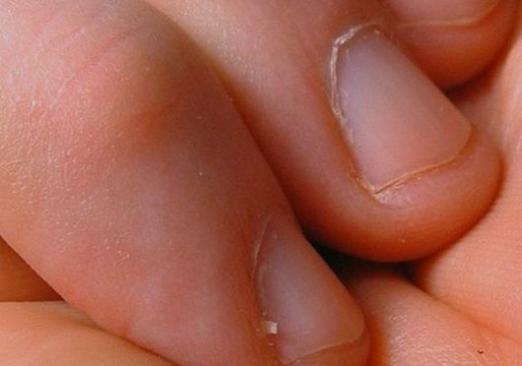 How to cure fingernails?