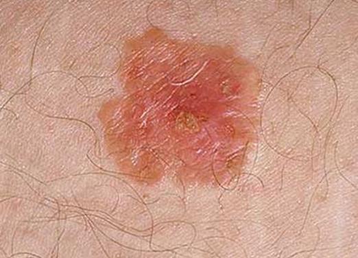 How to cure a papilloma?