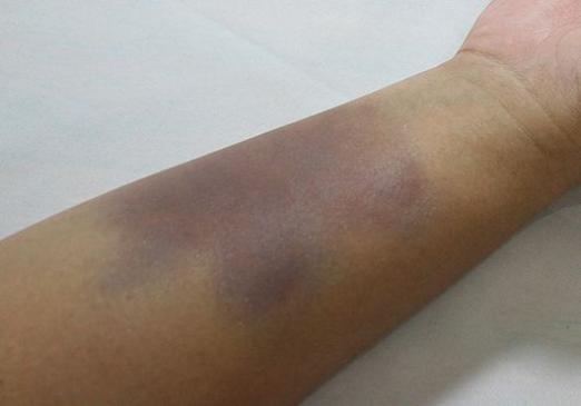 How to make a bruise?