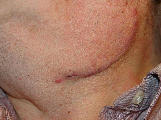 What if the lymph node has become inflamed?
