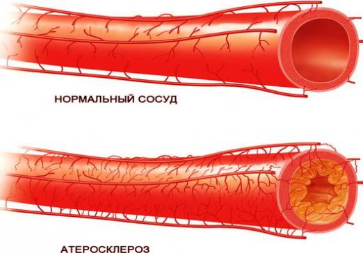 What is atherosclerosis?