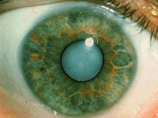 What is cataract?