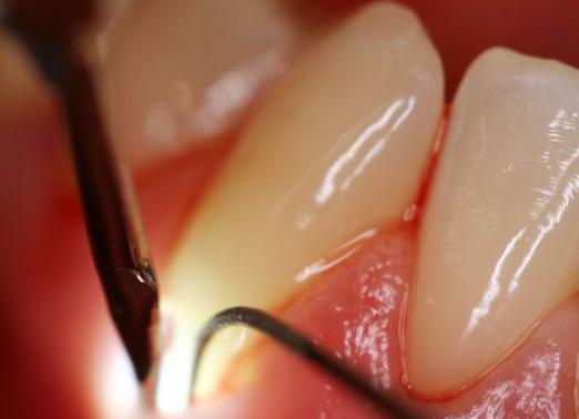 What is periodontal disease?