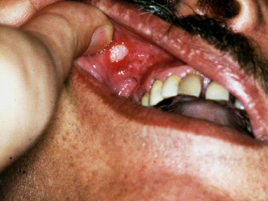 What is stomatitis?