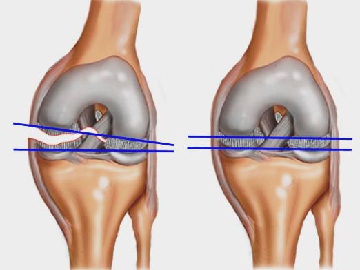 What are ligaments?