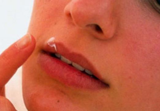 How to quickly cure herpes?