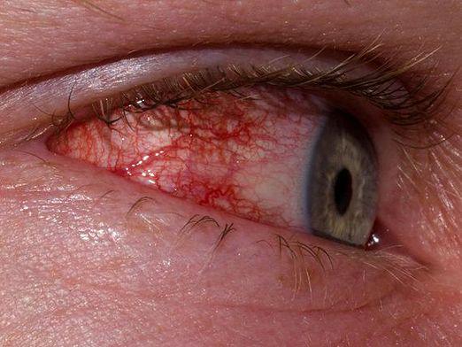 How to treat conjunctivitis?