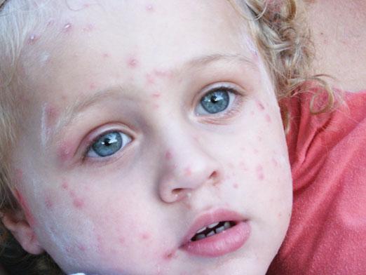 How can you get chickenpox?