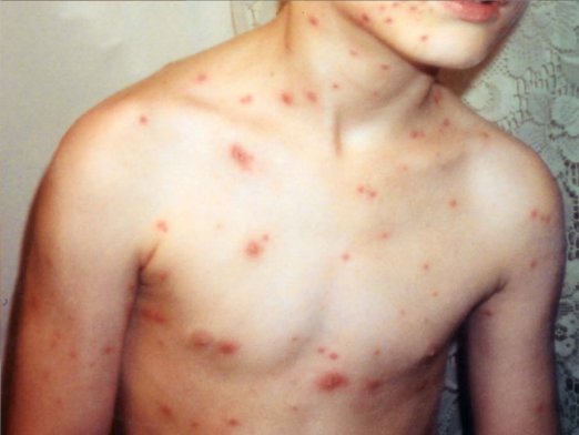 What does chickenpox look like?