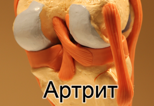 How to cure arthritis?