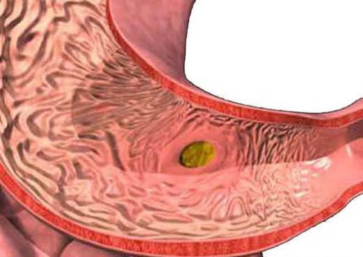 How to cure gastritis?