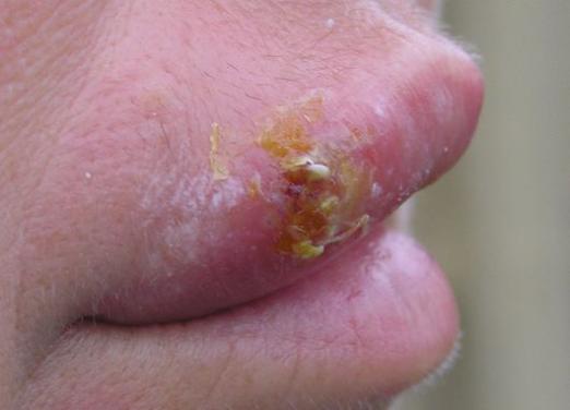 How to get infected with herpes?